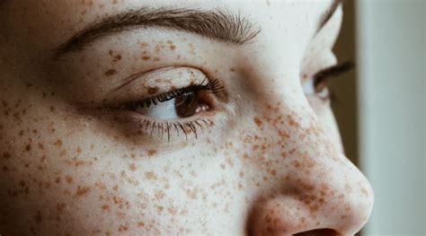 brown hair and freckles|developing freckles later in life.